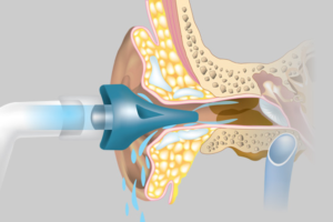 Otoclear schematic